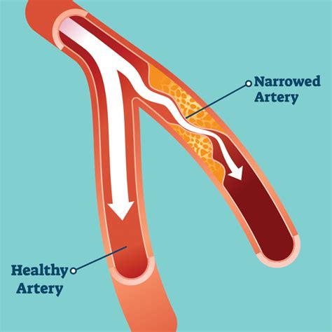 Peripheral Artery Disease Diagram