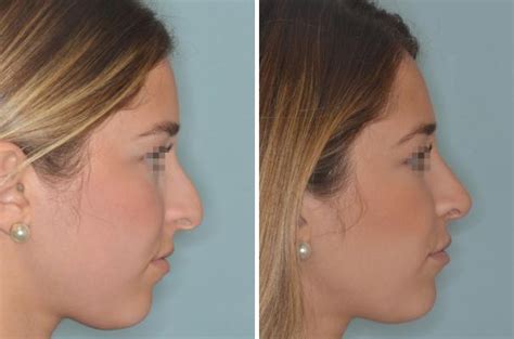 Rhinoplasty Photos Miami Fl Patient 543