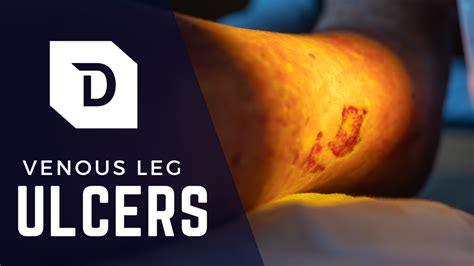 venous leg ulcers treatment district foot ankle