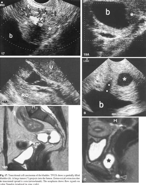 Figure 17 From Transvaginal Ultrasonography Of Nongynecologic Pelvic