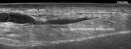 Baker Cyst Leaked Radiology Case Radiopaedia Org