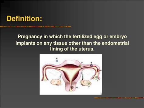 Ppt Ectopic Pregnancy Powerpoint Presentation Free Download Id3336180