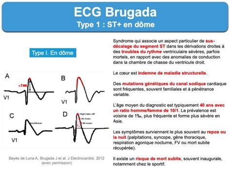 Syndrome De Brugada E Cardiogram