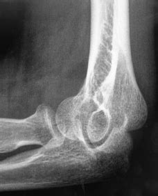 Preoperative Lateral Xray Of A Mason Hotchkiss Type Radial Head