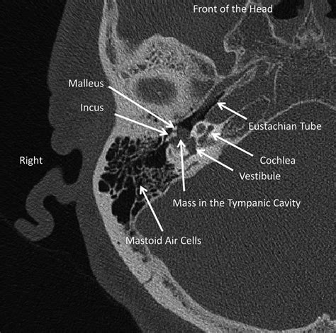 Axial Horizontal CT Of The Right Temporal Bone At The Level Of The