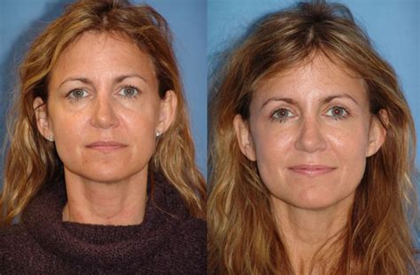 Eyelid Lifts Before And Afters Raval Facial Aesthetics Denver