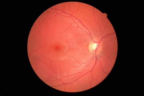 Edema Macular Causas Diagn Stico Y Tratamiento En Ojopedia