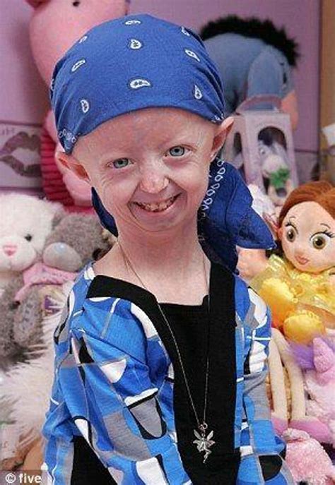 15 Fascinating Facts About Progeria The Rapid Aging Disease