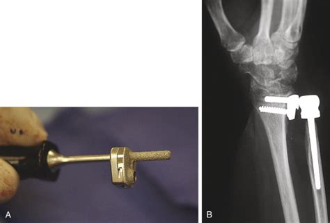 Arthroplasty of the Distal Radioulnar Joint | Musculoskeletal Key