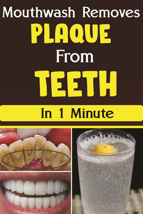 Mouthwash Removes Plaque From Teeth In 1 Minute