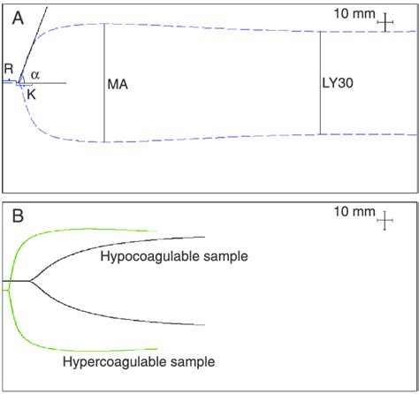 Thromboelastography tracings. A, Normal TEG ® ; B, examples of ...