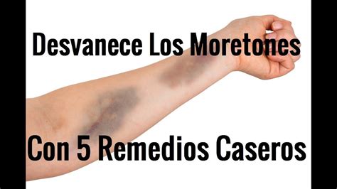 Desvanece Los Moretones De Tu Piel Con Remedios Caseros Youtube