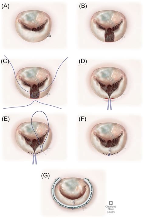 Mitral valve repair using a folding technique in patients with isolated ...