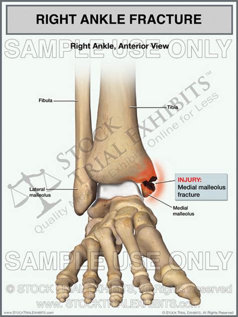 Medial Malleolus