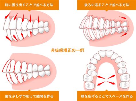 非抜歯矯正・4本抜歯、歯列矯正で抜歯は必要？ 明石市の歯医者 明石アップル歯科