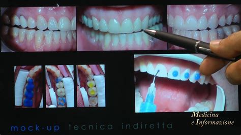 Odontoiatria Estetica Faccette le ultime novità di materiali e