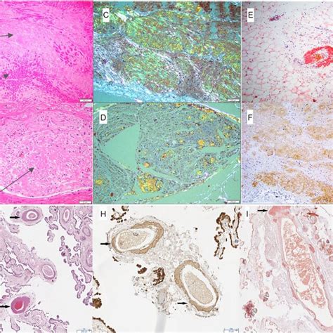 Postmortem Examination Extensive Amyloid Deposition Seen Here As