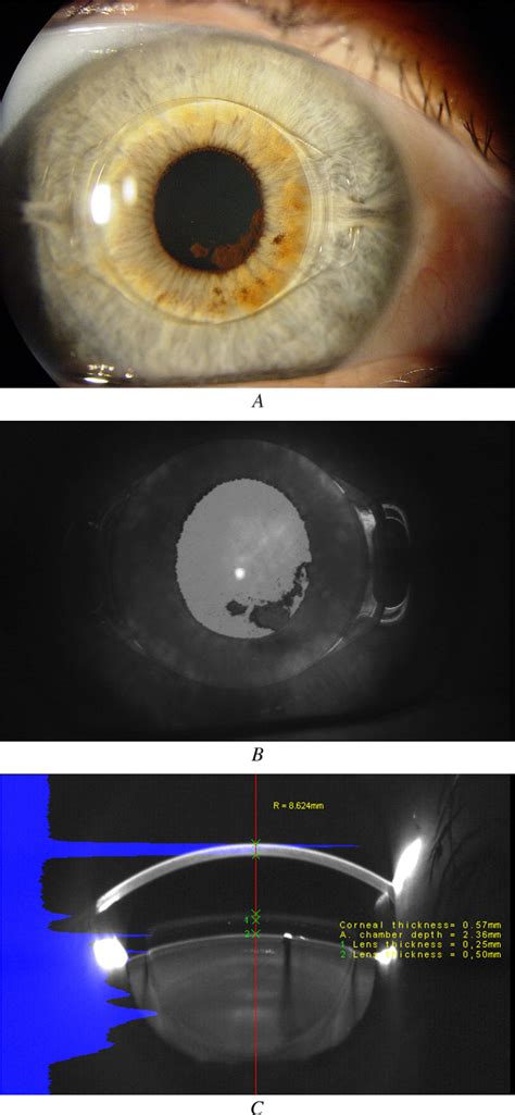 Posterior Synechias Following Implantation Of A Foldable Silicone Iris