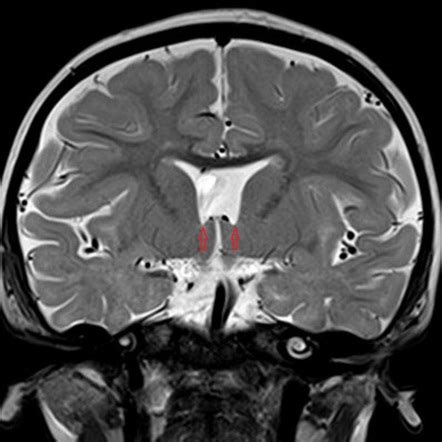 Septo Optic Dysplasia Image Radiopaedia Org