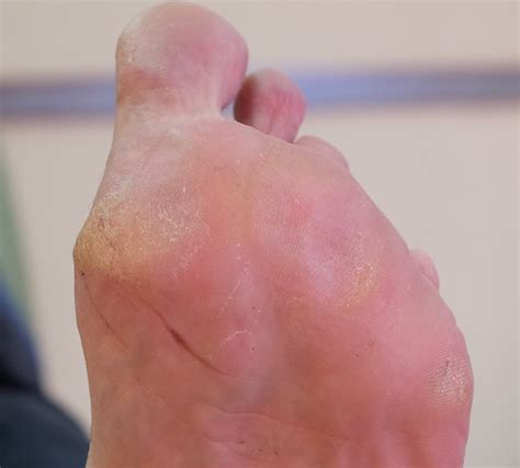 What causes calluses to develop? - Feel Your Feet