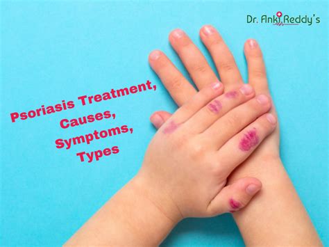 Psoriasis Treatment Causes Symptoms Types