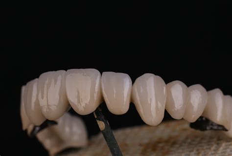 Pfm Crown And Bridge Porcelain Fused To Metal Provisional