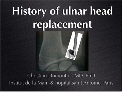 (PDF) History of ulnar head replacement - ClubOrtho.fr - Le ... · History of ulnar head ...