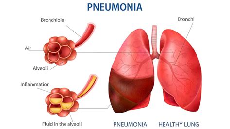 Pneumonia Symptoms Causes Treatment And Diet