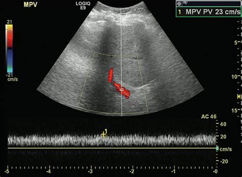 Imaging Findings Of Congestive Hepatopathy Radiographics