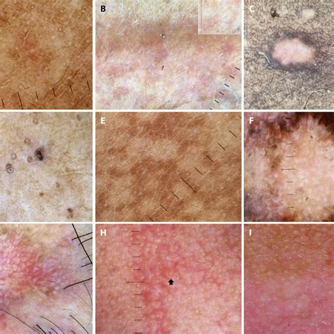 Examples Of Dermoscopic Clues Of Hypopigmented Dermatoses In