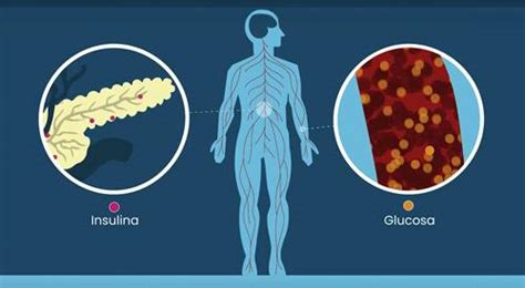 Diabetes Mellitus Tipo 1 Síntomas Causas E Investigación Clínica