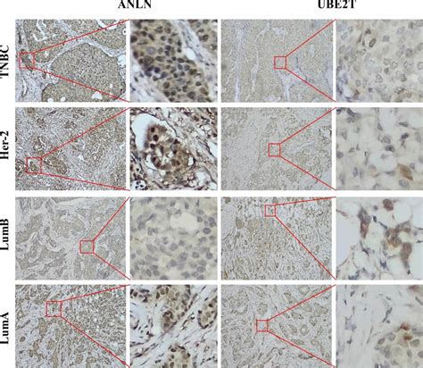 Expression Of Anln And Ube T In Breast Cancer Tissues Representative