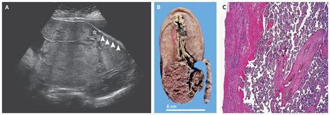 Placenta Increta New England Journal Of Medicine