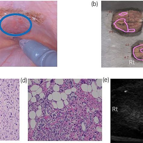 A Intraoperative Endoscopic Findings The Multiple Central Nodules