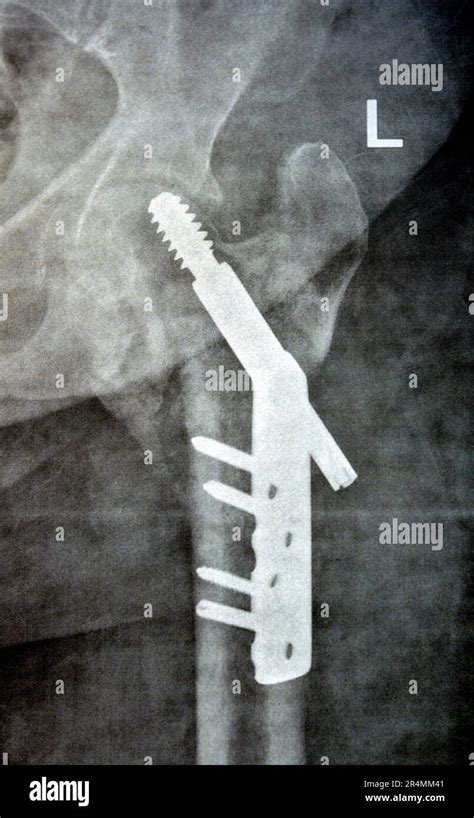 Col cervical trans de la hanche gauche de la fracture du fémur fixé par