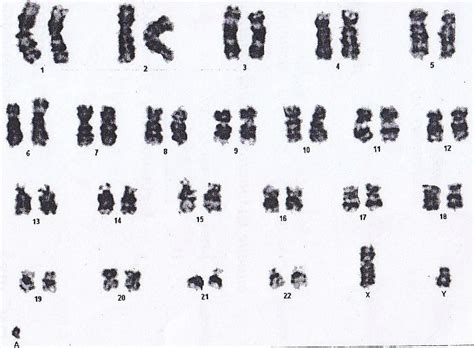 Karyotype Of The Patient With Marker Chromosome 47xymar 3 46xy