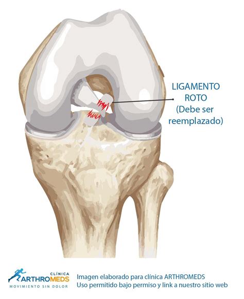 Cirugía de ligamento cruzado anterior LCA posterior LCP y colaterales