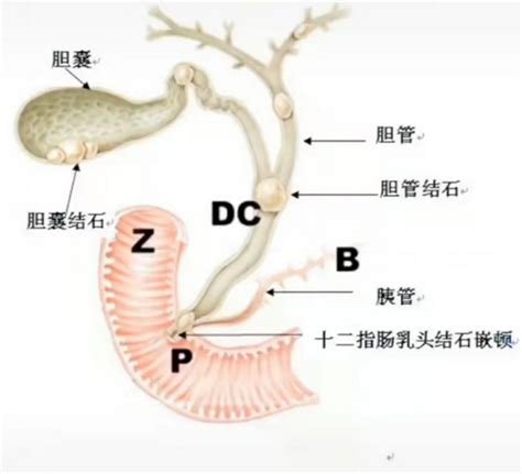 哈医大四院松北内镜中心开展经内镜逆行胰胆管造影术（ercp）新浪黑龙江新浪网