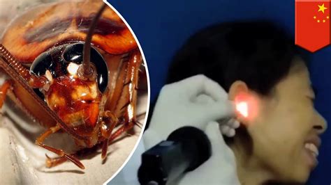 Cockroach In Ear Video Of Chinese Woman Have Having Live Insect Pulled From Ear Tomonews