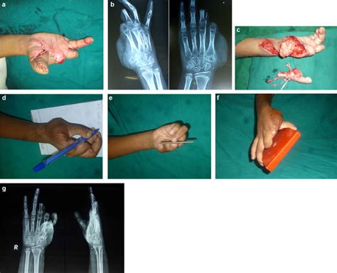 Reconstruction Of The Thumb Amputation At The Carpometacarpal Joint