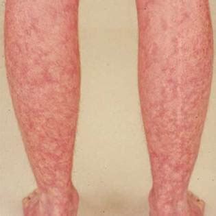 Identifying Rheumatoid Arthritis Rash: Livedo Reticularis