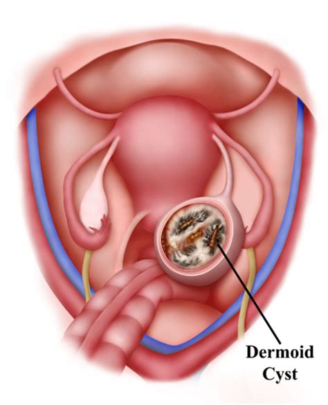 Dermoid Ovarian Cyst By Priapism4art On Deviantart 56 Off