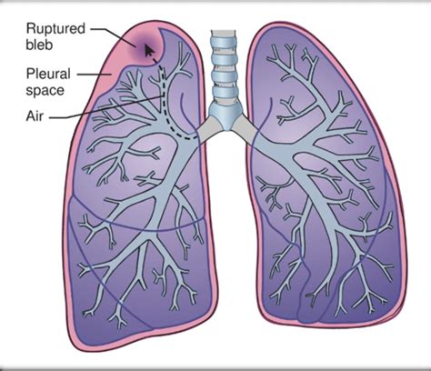 Pulmonary Patho 2 Flashcards Quizlet