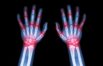 PRP Injections For Arthritis | New York, NY