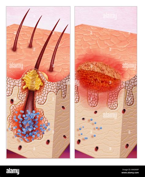 Opportunistic Infection Immagini E Fotografie Stock Ad Alta Risoluzione