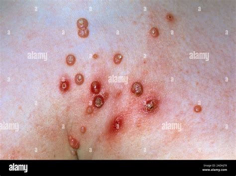 Molluscum Contagiosum Pus Filled Lesions On The Skin Of A Nine Year