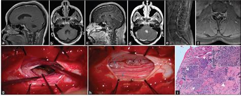 Isolated Neurosarcoidosis Presenting With Recurrent Hydrocephalus