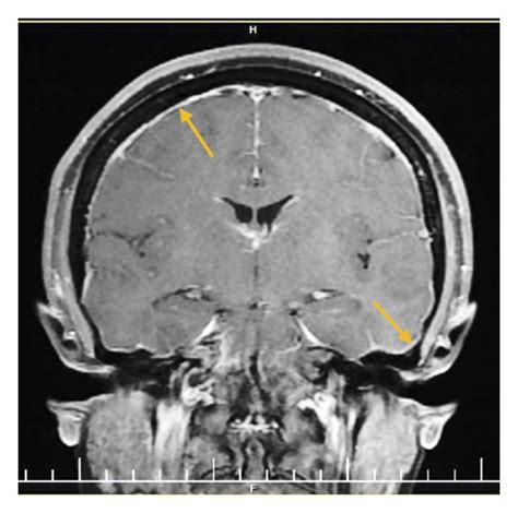 Brain MRI of patient demonstrating (a) cerebellar tonsillar herniation ...