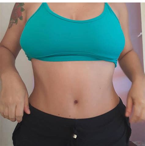 Abdominoplastia Corre O Da Diastese E Mamoplastia Redutora Sem