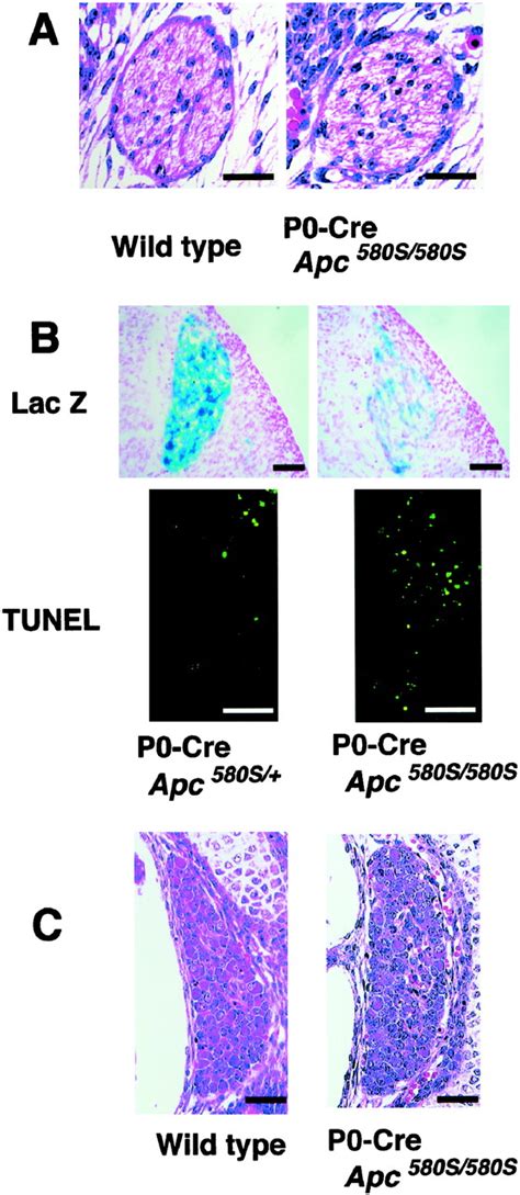 Apoptosis In Neural Crest Cells By Functional Loss Of Apc Tumor